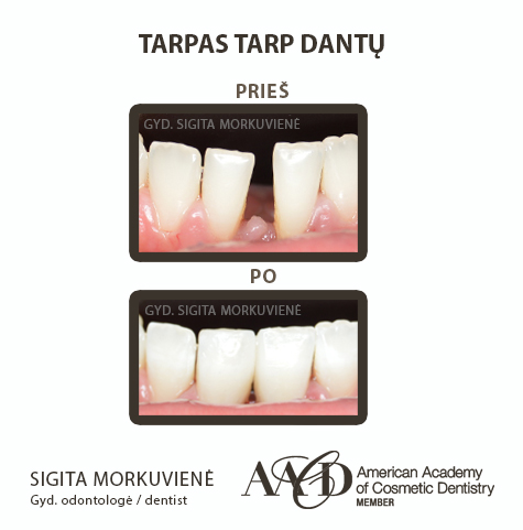 Gaps between teeth   